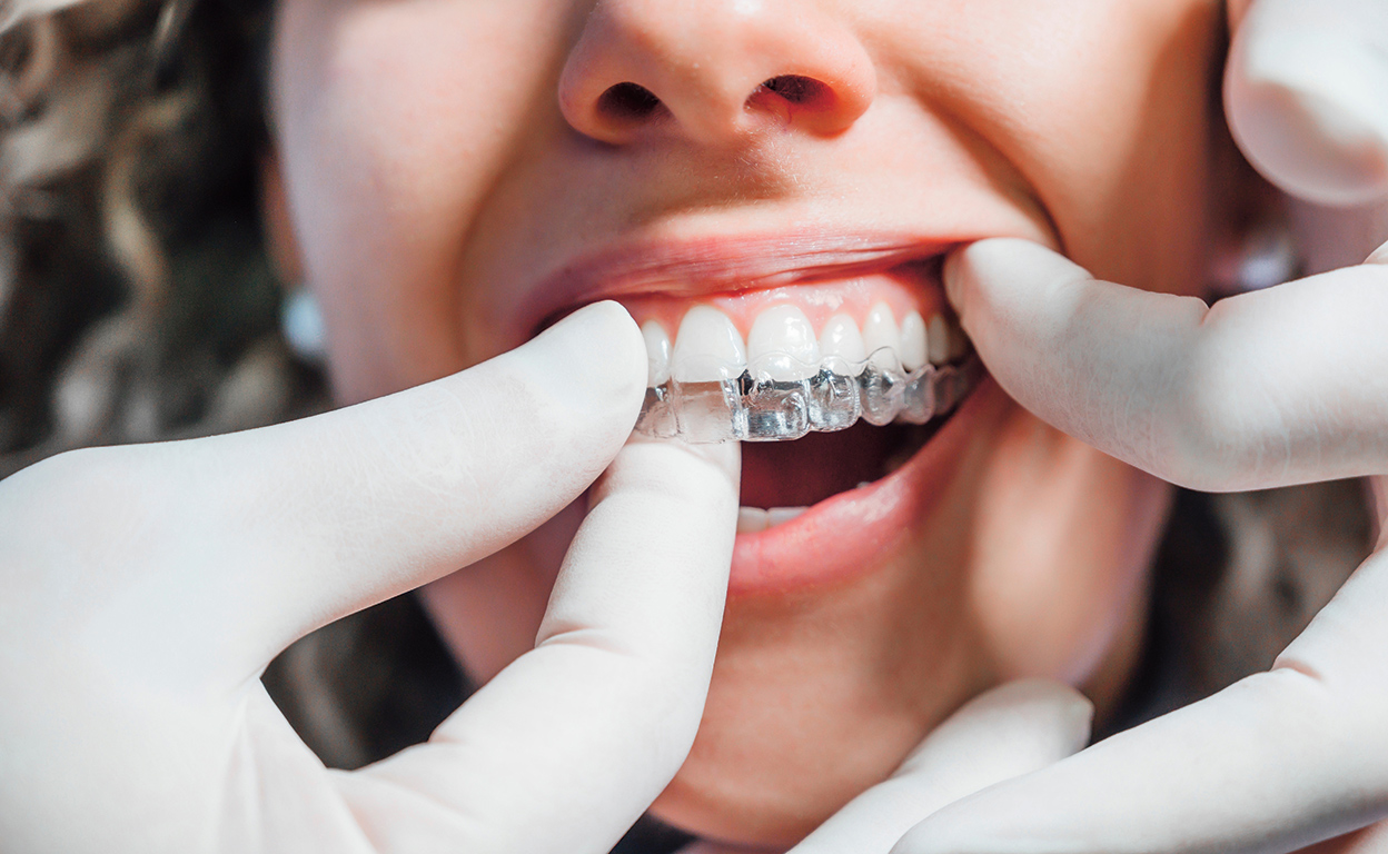 El riesgo de las férulas dentales para tu salud